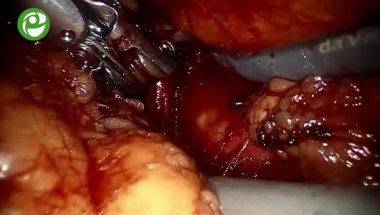 Робот-ассистированная резекция левой почки с опухолевым узлом