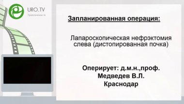Лапароскопическая нефрэктомия слева (дистопированная почка)