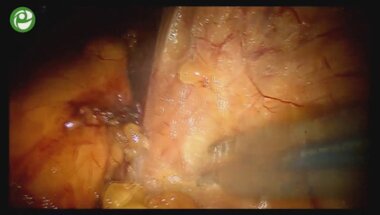 Лапароскопическая роботизированная резекция почки