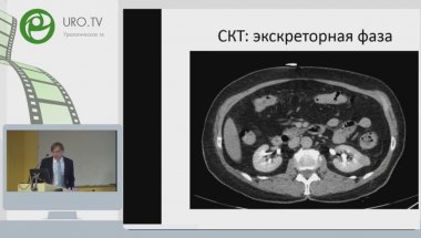 Ретроперитонеоскопическая резекция почки с опухолью