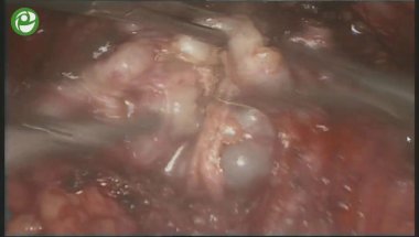 Экстраперитонеальная видеоэндоскопическая радикальная нервсберегающая простатэктомия