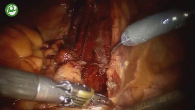 Лапароскопическая роботизированная радикальная простатэктомия, расширенная тазовая лимфаденэктомия