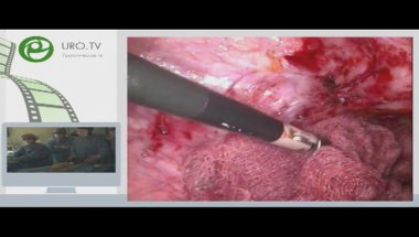 Лапароскопическая пластика мочеточника по Боари