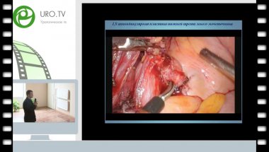 Орлов И.Н. - Лапароскопическая аппендикулярная пластика нижней трети левого мочеточника