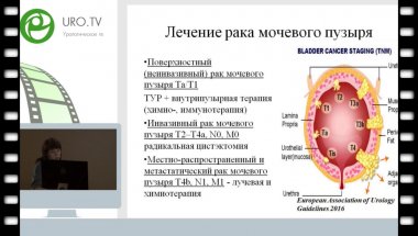 Слесаревская М.Н. - Фотодинамические методы в диагностике и лечении поверхностного рака мочевого пузыря