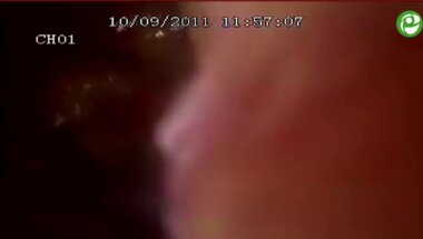 Лапароскопическая радикальная простатэктомия