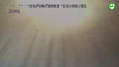 Лапароскопическая резекция почки