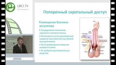 Кызласов П.С. - Ведение пациентов с искусственным сфинктером уретры