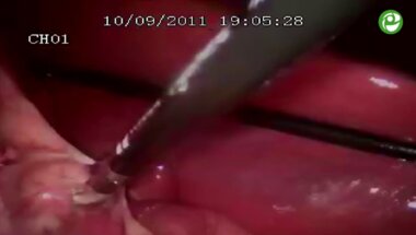 Лапароскопическая нефрэктомия