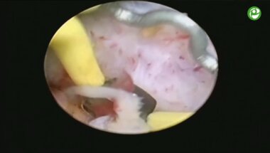 Биполярная электроэнуклеация гиперплазии простаты