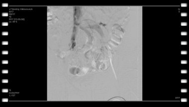 Капто А.А. Габлия М.Ю. Ангиопластика и стентирование у мужчины при May-Thurner Syndrome.
