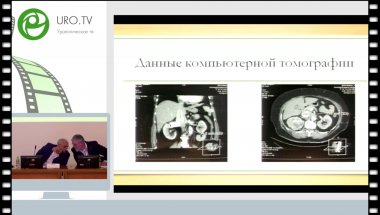 Михайликов Т.Г. - Лапароскопическая нефрэктомия с удалением тромба из нижней полой вены
