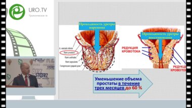 Курбатов Д.Г. - Эндоваскулярная эмболизация при аденоме простаты