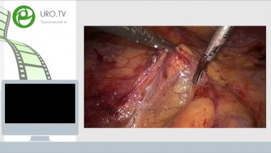 Робот-ассистированная резекция почки (В.Л. Медведев),  Лапароскопическая радикальная нефрэктомия (И.В. Михайлов), Нефроскопия, нефролитотрипсия (Г.Д. Дмитренко), Трансуретральная резекция опухоли мочевого пузыря (А.И. Стреляев)