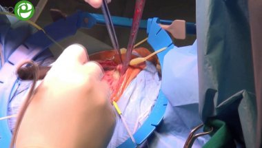 Транскорпоральная имплантация искусственного мочевого сфинктера - Котов С.В.