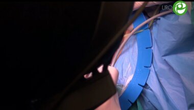 Анастомотическая пластика конец в конец - Котов С.В.