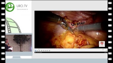 Павлов В.Н. - Тазовая эвисцерация с формированием илеокондуита с трансвагинальной экстракцией органокомплекса