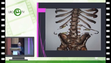 Малханов  Ш.В  - Опыт перкутанной хирургии в Забайкальском крае