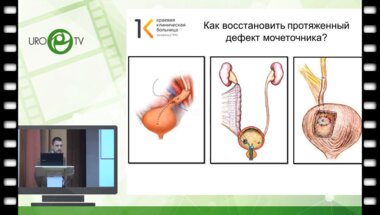 Лалетин Д.И. - Случай аппендикулоуретеропластики справа