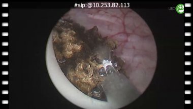 Тулиевая энуклеация простаты единым блоком