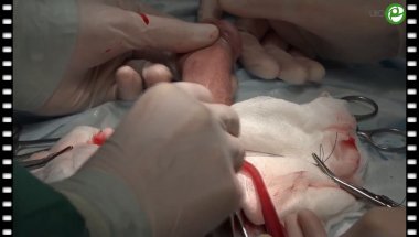 Болезнь Пейрони. Эректильная дисфункция. Фаллоэндопротезирование