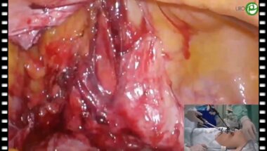 Лапароскопическая пластика мочеточника