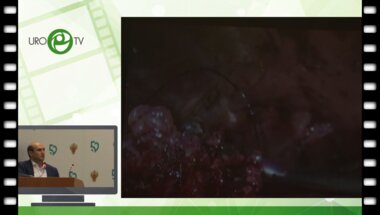 Гебенов М. Х.  - Лапароскопическая резекция при синхронном двустороннем опухолевом поражении