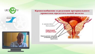 Курбатов Д.Г. - Эмболизация простатических артерий в лечении ДГПЖ