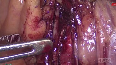 Носов А.К. - Лапароскопическая простатэктомия