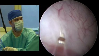 Дымов А.М. - Лазерная резекция опухоли мочевого пузыря единым блоком (en-bloc)