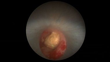 Цариченко Д.Г. - Перкутанная нефролитотрипсия (PCNL)