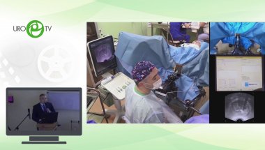 Еникеев Д.В.  - Фокальный нанонож (необратимая электропорация)