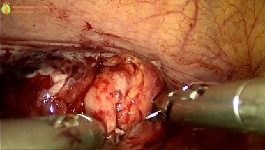 Овчинников К.А. -  Операция  "Лапароскопическая фистулопластика"