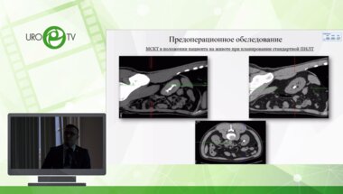 Сулейманов М.М. - Индивидуальный подход при планировании перкутанной нефролитотрипсии