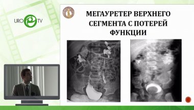 Доброседов Д.А. - Наш опыт применения лапароскопического доступа при лечении заболевания удвоенной почки у детей