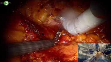 Абоян И.А. - Робот-ассистированная нервосберегающая простотэктомия. Боковой доступ