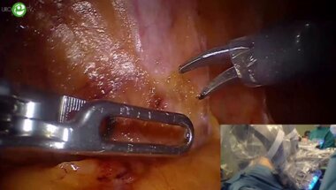 Богданов А.Б. - Робот-ассистированная резекция левой почки с опухолевым узлом