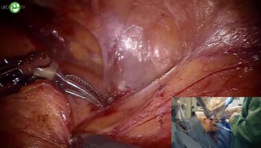 Попов Д.М. - Робот-ассистированная радикальная нефрэктомия