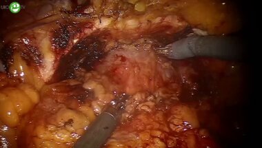 Сосновский И.Б. - Робот-ассистированная радикальная простатэктомия с невросбережением