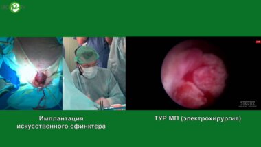 Lledo E. - Имплантация искусственного сфинктера