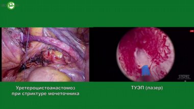 Севрюков Ф.А. - ТУЭП (лазер)