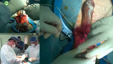 Топузов Т.М. - Имплантация трехкомпонентного фаллопротеза