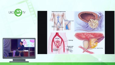Неймарк Б.А. - Эндоваскулярные методы лечения при заболеваниях предстательной железы