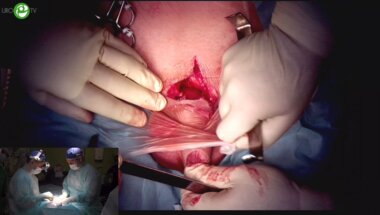 Гулько А.М. - Лигаментотомия полового члена