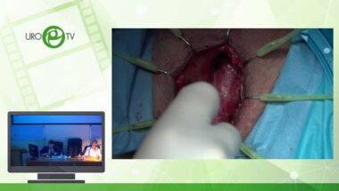 Анастомотическая пластика луковичного отдела уретры. Анастомотическая увеличивающая пластика луковичного отдела уретры