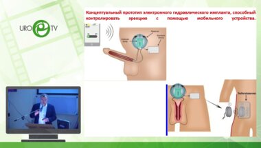 Корниенко А.М. , Шамраев С.Н. - Наш опыт и предпочтения альбугеальной реконструкции