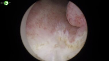 Тулиевая лазерная энуклеация гиперплазии простаты. РИРХ. Лазерная en-bloc резекция стенки мочевого пузыря с опухолью