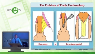 Барбали Г. - Реконструктивные операции при простых и осложненных стриктурах уретры. Обзор проблемы и новые подходы