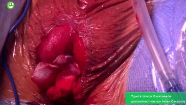 Одноэтапная буккальная уретропластика при Лихен Склерозе