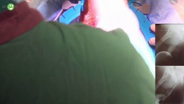 Пластика буккальным графтом (Аугментационный анастомоз)